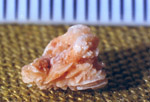 Πέτρες στα νεφρά Kidney stones